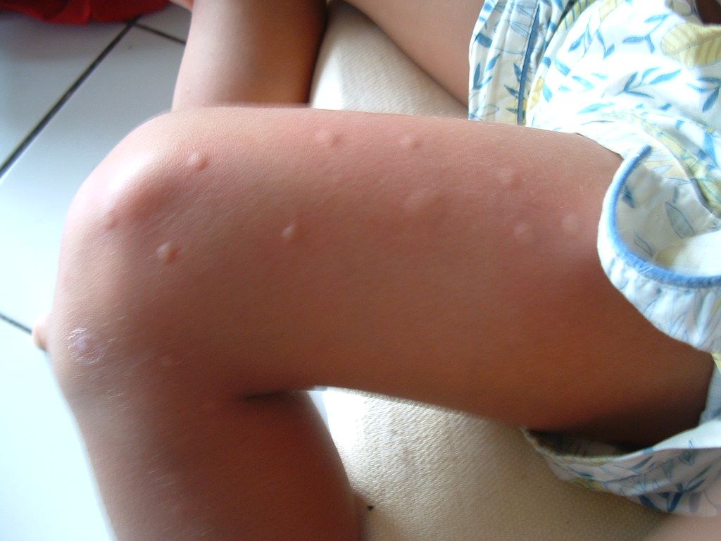Een mensenbeen vol met een muggenbulten, een muggenbeet kan erg vervelend zijn. 